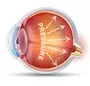 Glaucoma Treatment Ophthalmologist New Castle Johannesburg Dr Junaid Zondi