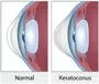 Keratoconus Treatment Ophthalmologist New Castle Johannesburg Dr Junaid Zondi