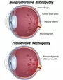 Diabetic Retinopathy Ophthalmologist New Castle Johannesburg Dr Junaid Zondi