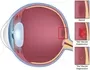 Age Related Macular Degeneration Ophthalmologist New Castle Johannesburg Dr Junaid Zondi